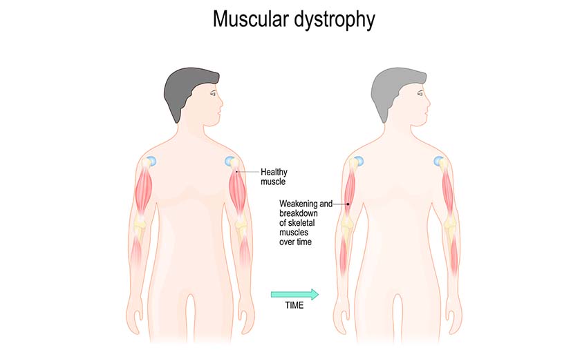 Physical Therapy for Muscular Dystrophy Benefits and How It Helps