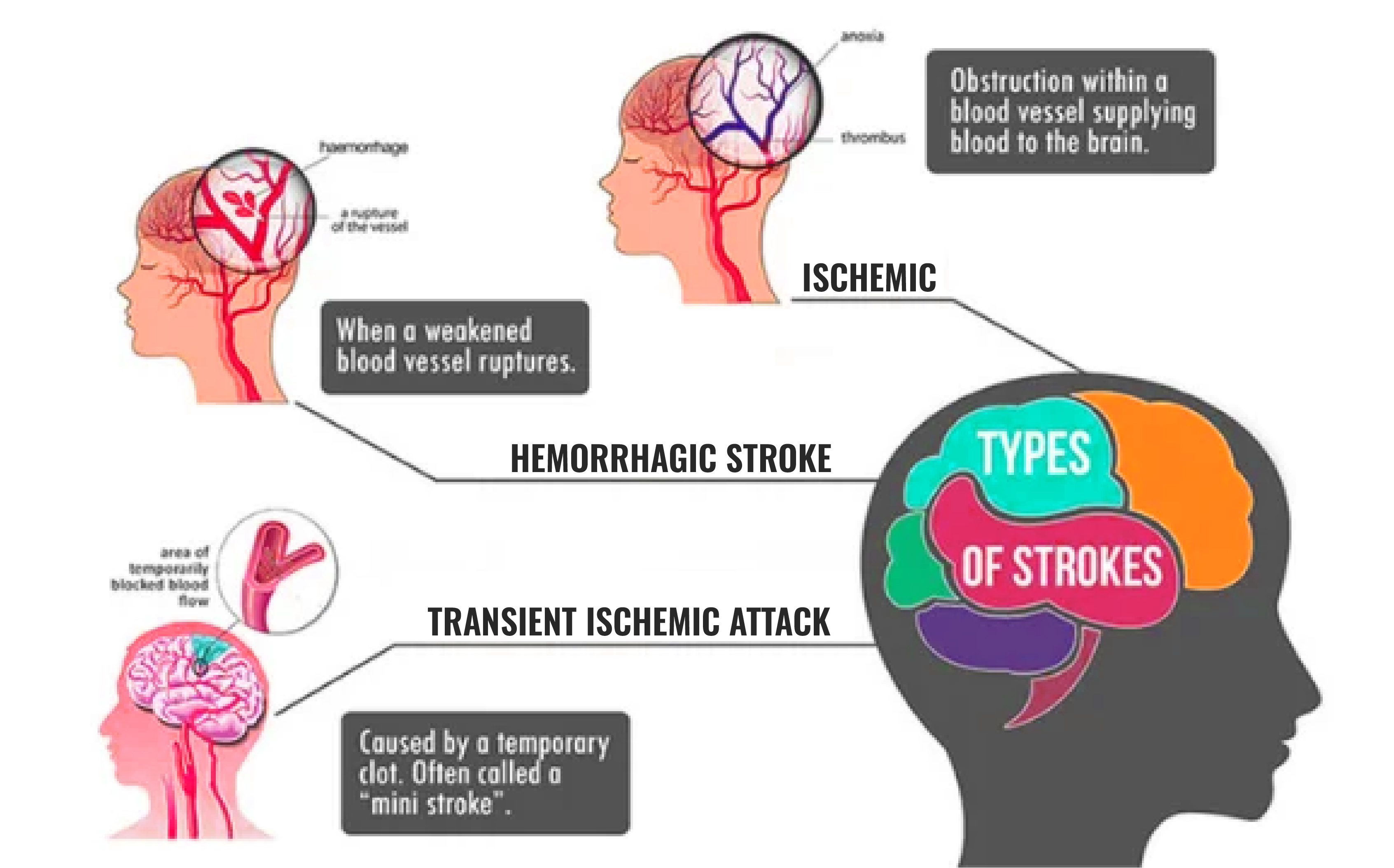 Understanding Stroke Recovery Time and Effective Treatments