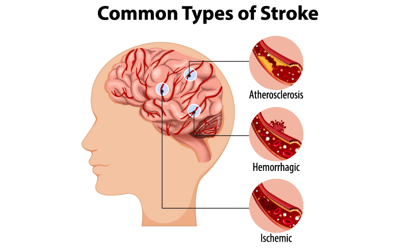 What Is a Brain Stroke- Know Its Causes, Symptoms And Treatment Methods