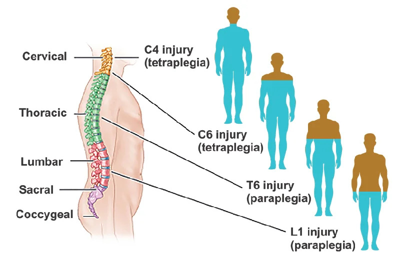 Neurorehabilitation Program For Spinal Cord Injury