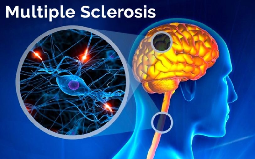 Exploring Multiple Sclerosis Treatment Options in Bangalore: A Comprehensive Guide